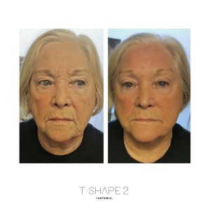 After-1-treatment