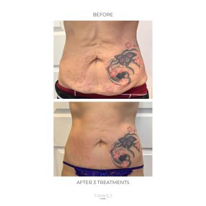 After-3-treatments