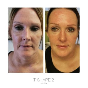 After-4-treatments